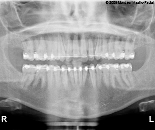 Marie-Hélène Cyr - Panoramic X-ray before the orthognathic surgery (March 5, 2008)